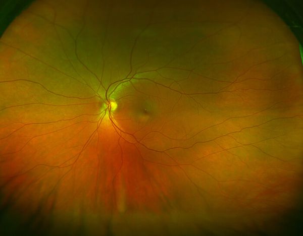 Optomap® ultra-widefield retinal imaging: